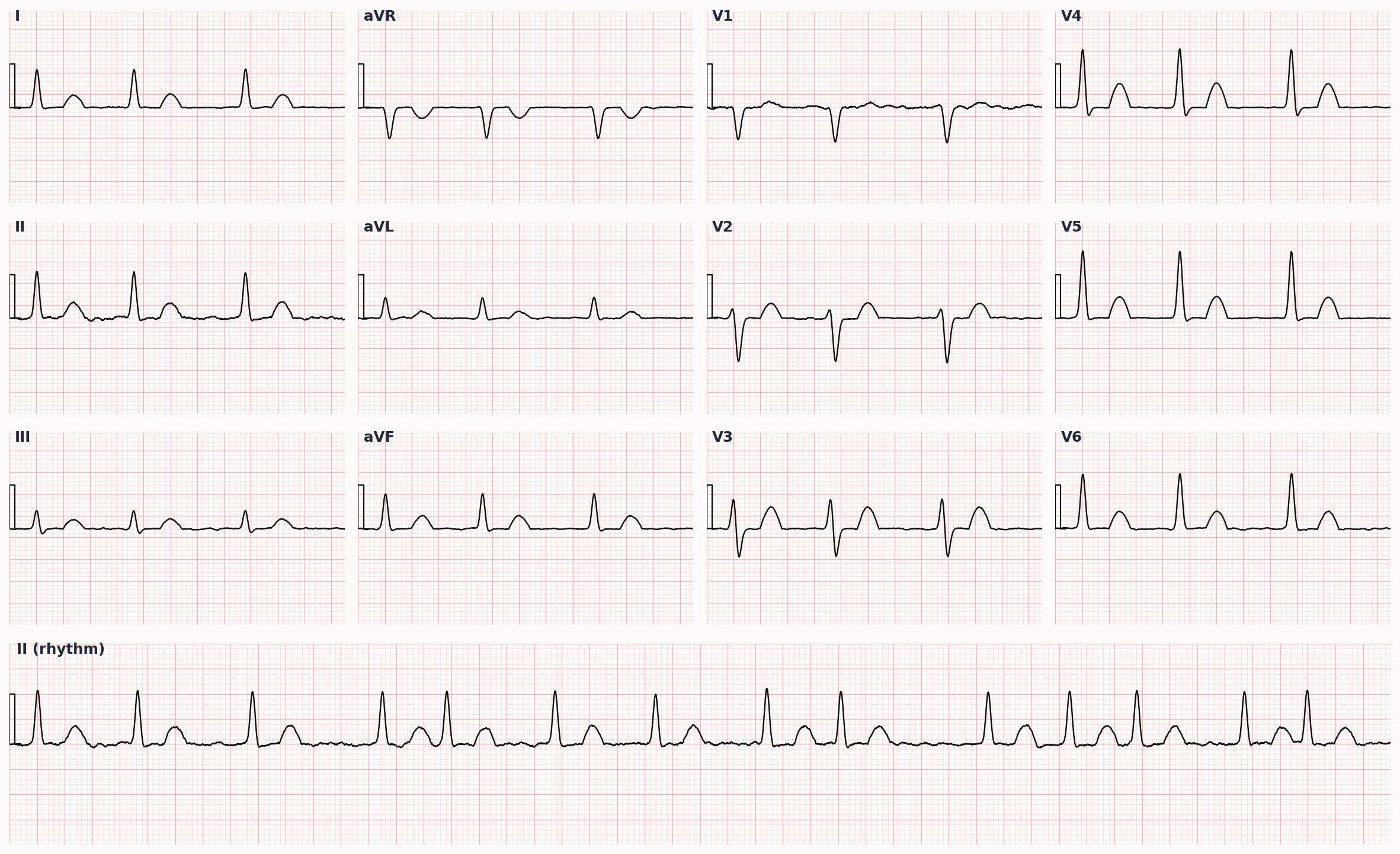 Atrial fibrillation — irregularly irregular rhythm with absent P waves and fibrillatory baseline