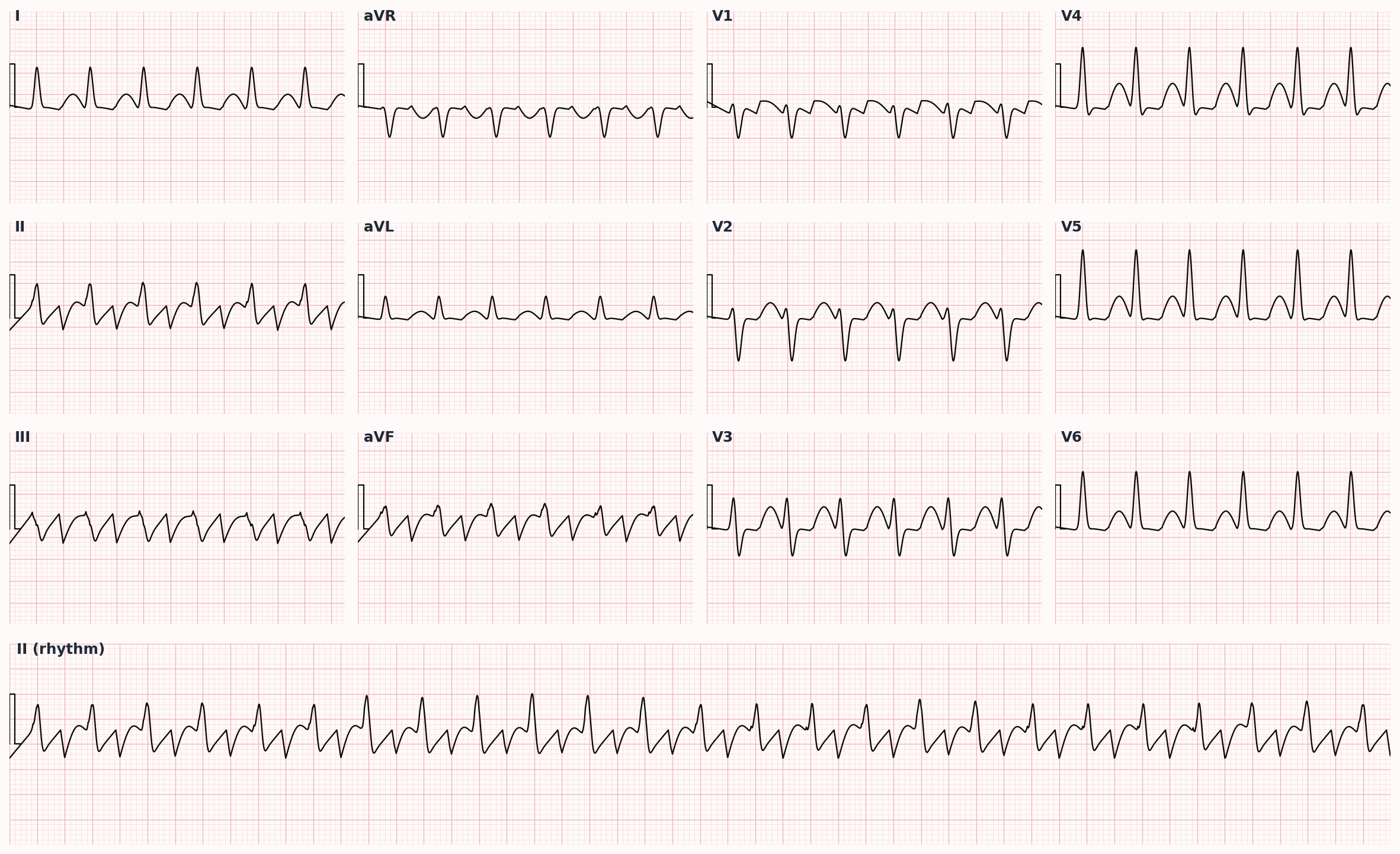 Atrial flutter — sawtooth flutter waves (negative in II, III, aVF) with regular ventricular response