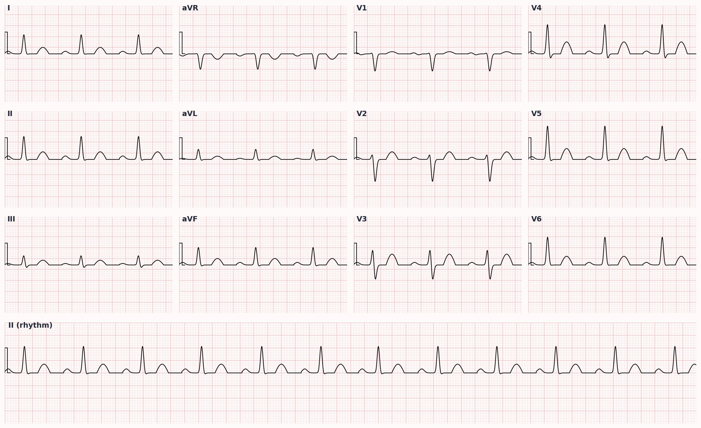 First-degree AV block — PR interval prolonged >200 ms, every P wave conducted