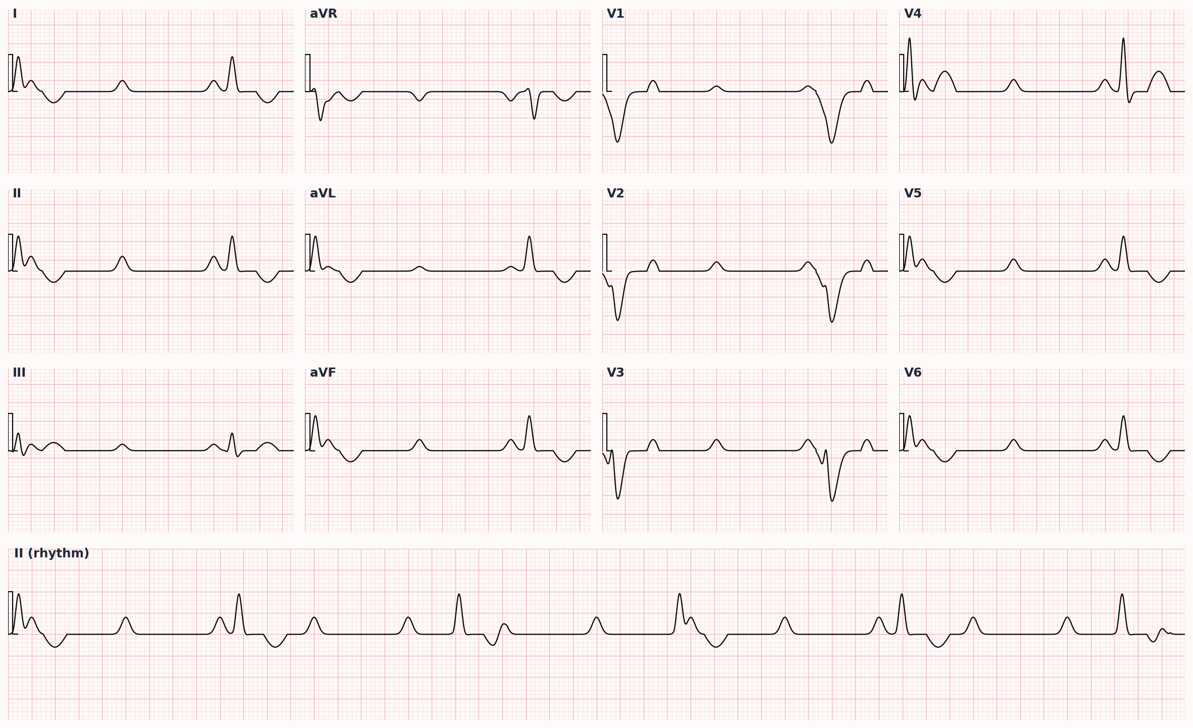 Third-degree (complete) AV block — AV dissociation; atrial and ventricular rates independent