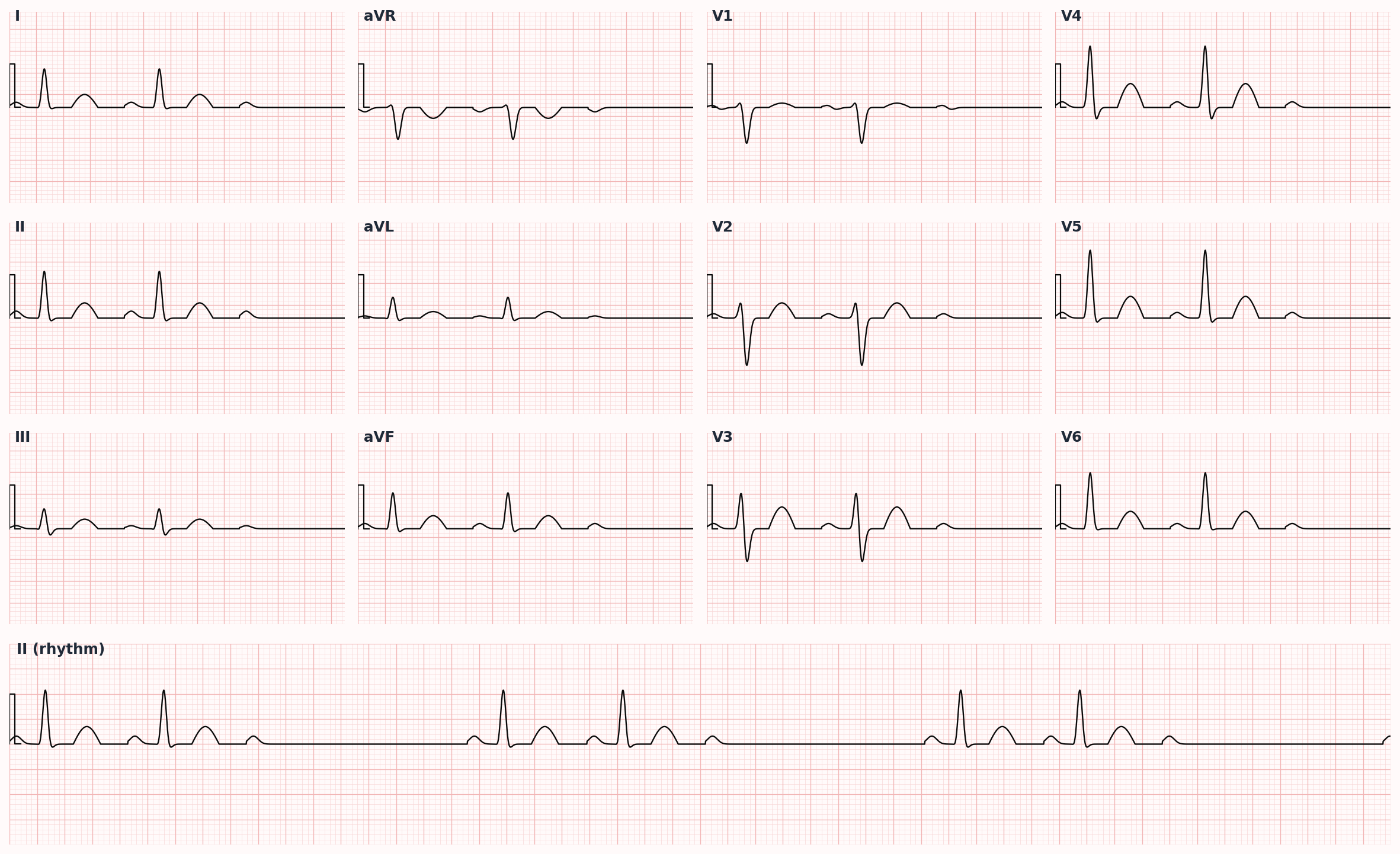 Mobitz II — fixed PR interval with intermittent non-conducted P waves; high risk of progression
