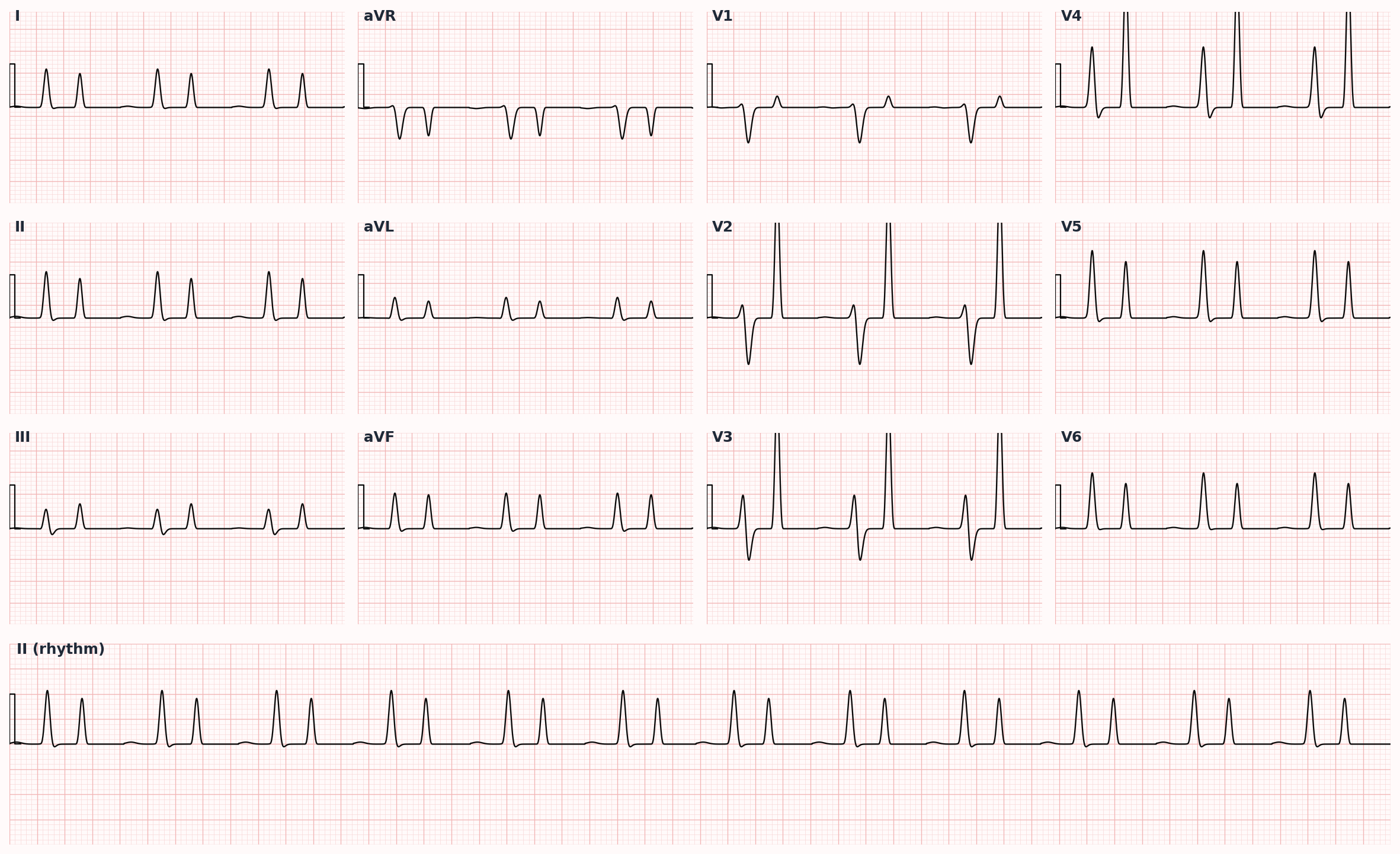 Hyperkalemia ECG progression — peaked T waves (early) → PR prolongation → QRS widening → sine wave (terminal)