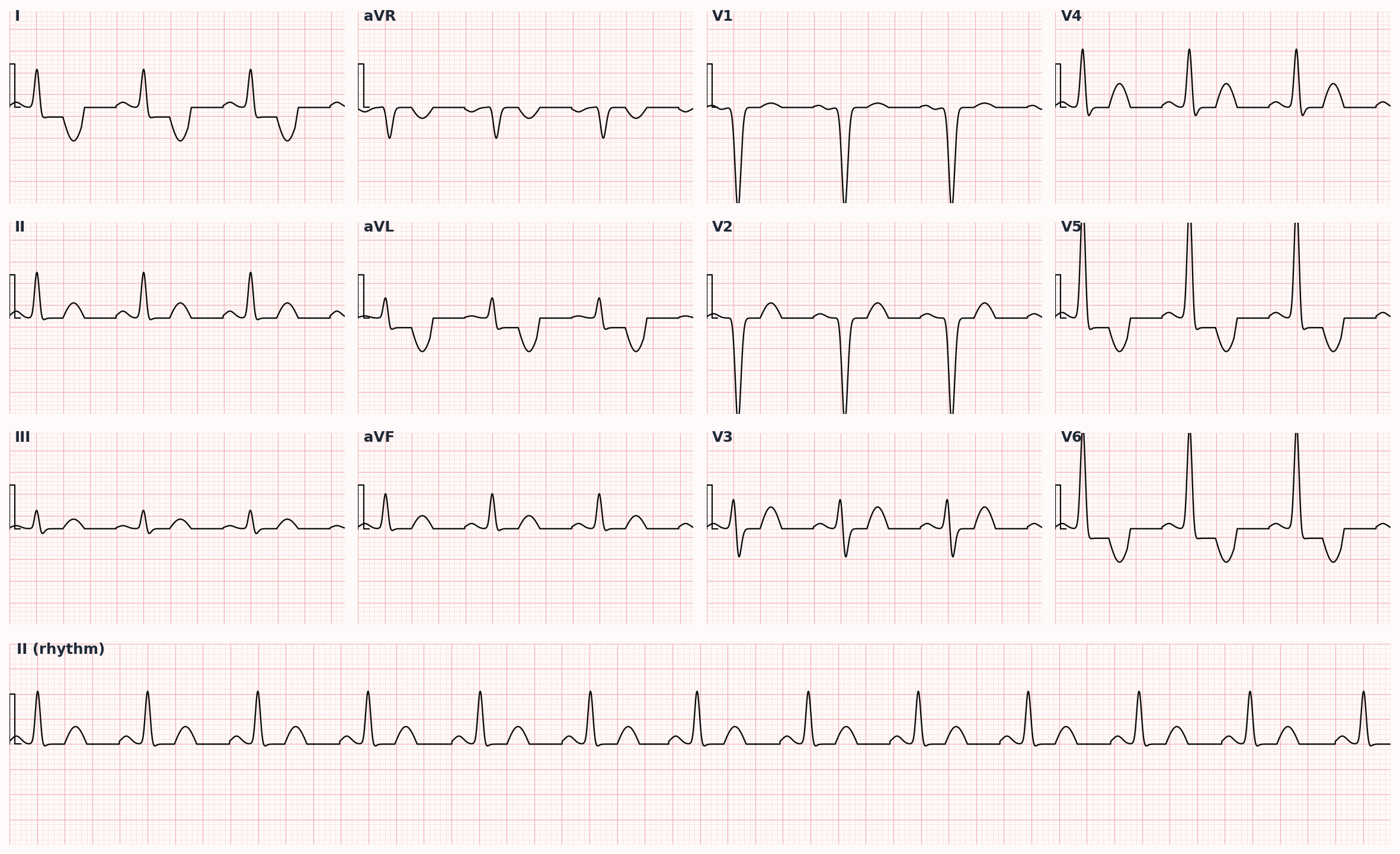Left ventricular hypertrophy — chronic hypertension causes voltage criteria (Sokolow-Lyon, Cornell) and "strain" pattern