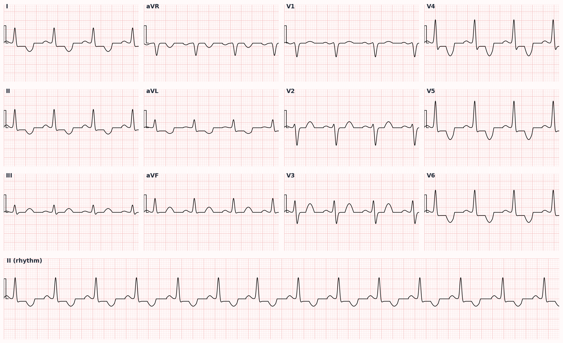 NSTEMI — ST-segment depression and T-wave inversion without ST elevation