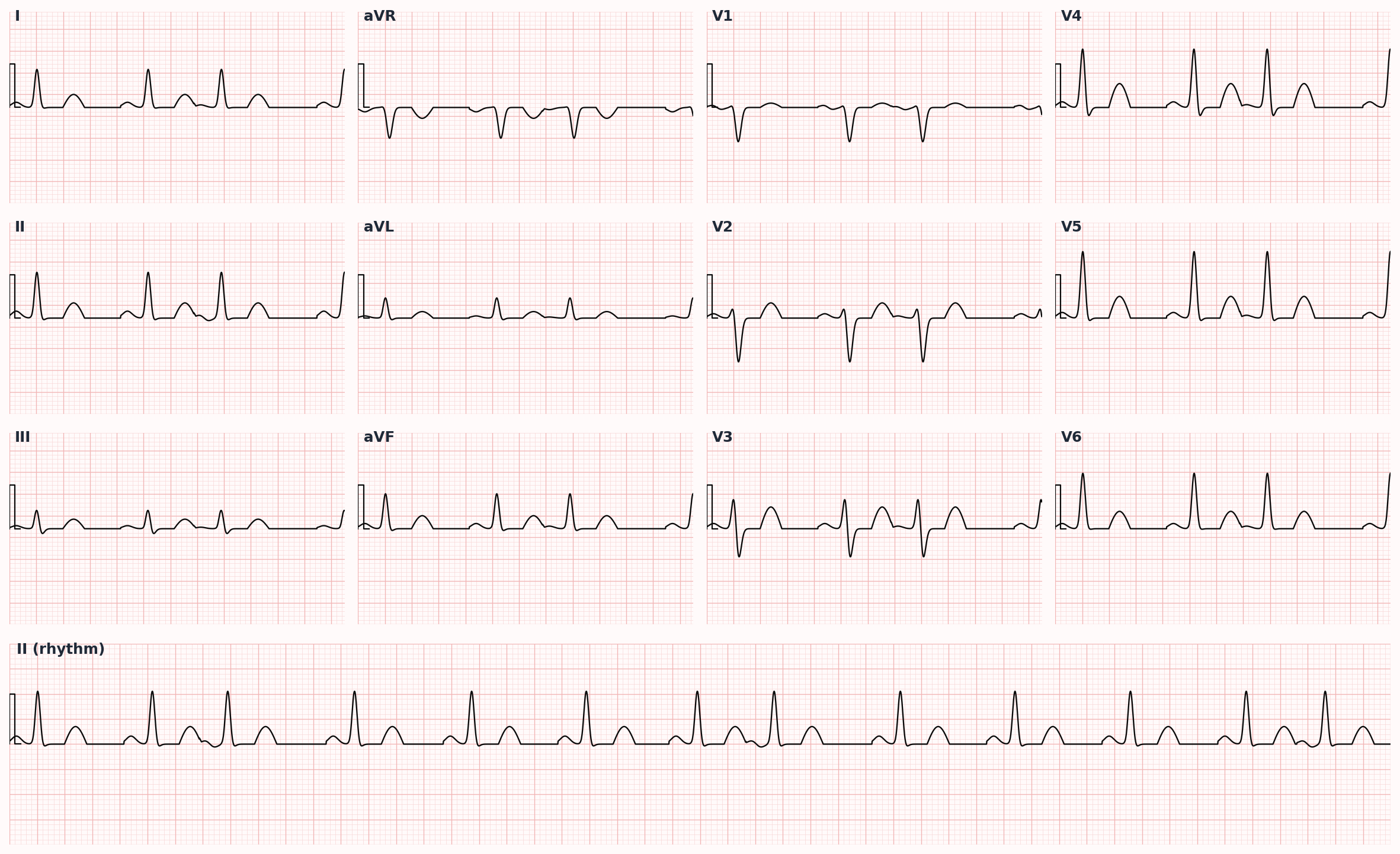 Premature atrial contraction — early P wave with abnormal morphology, narrow QRS