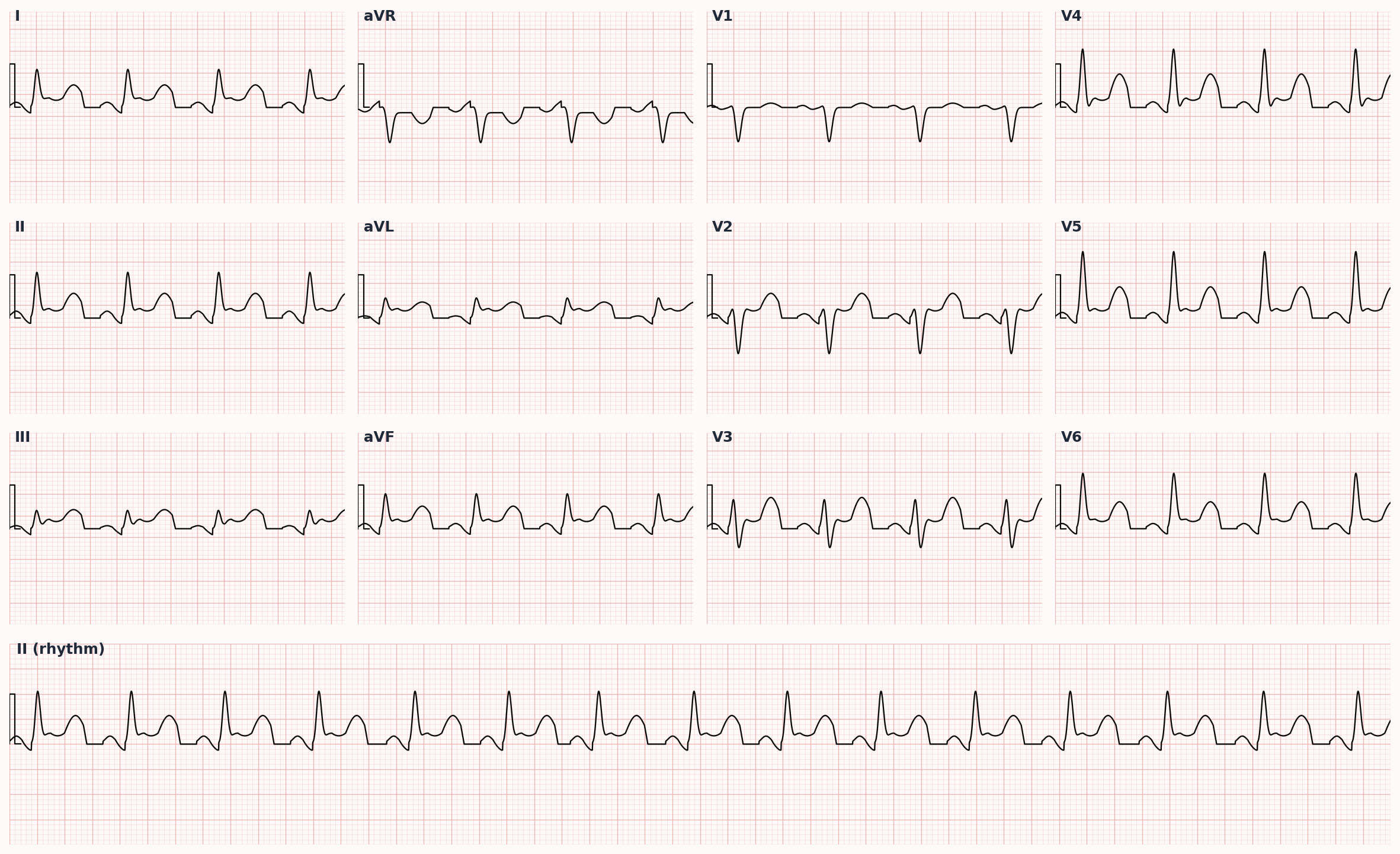 Acute pericarditis — diffuse concave ST elevation across multiple leads with PR-segment depression