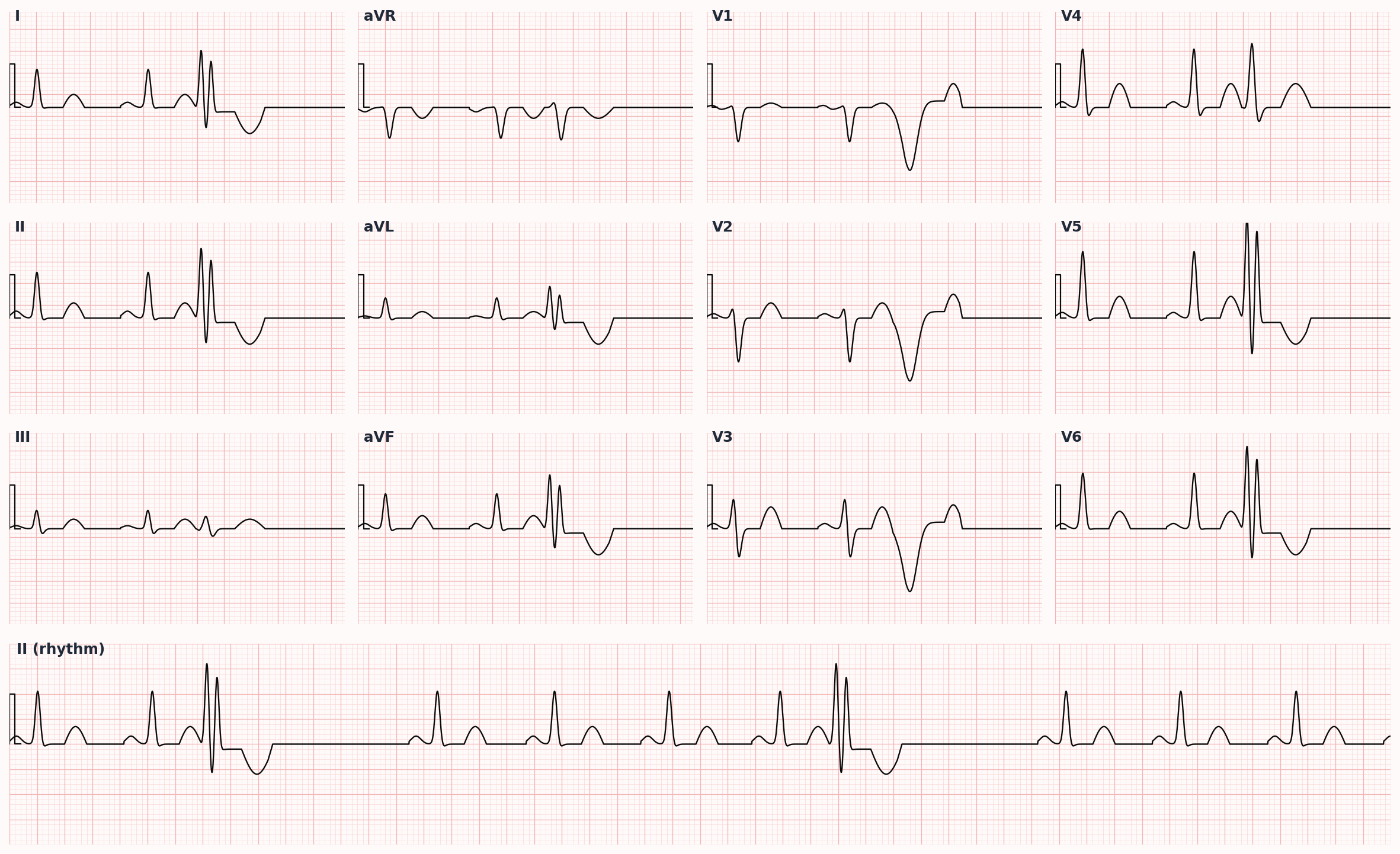 Premature ventricular contraction — wide, bizarre QRS without preceding P wave, often followed by compensatory pause