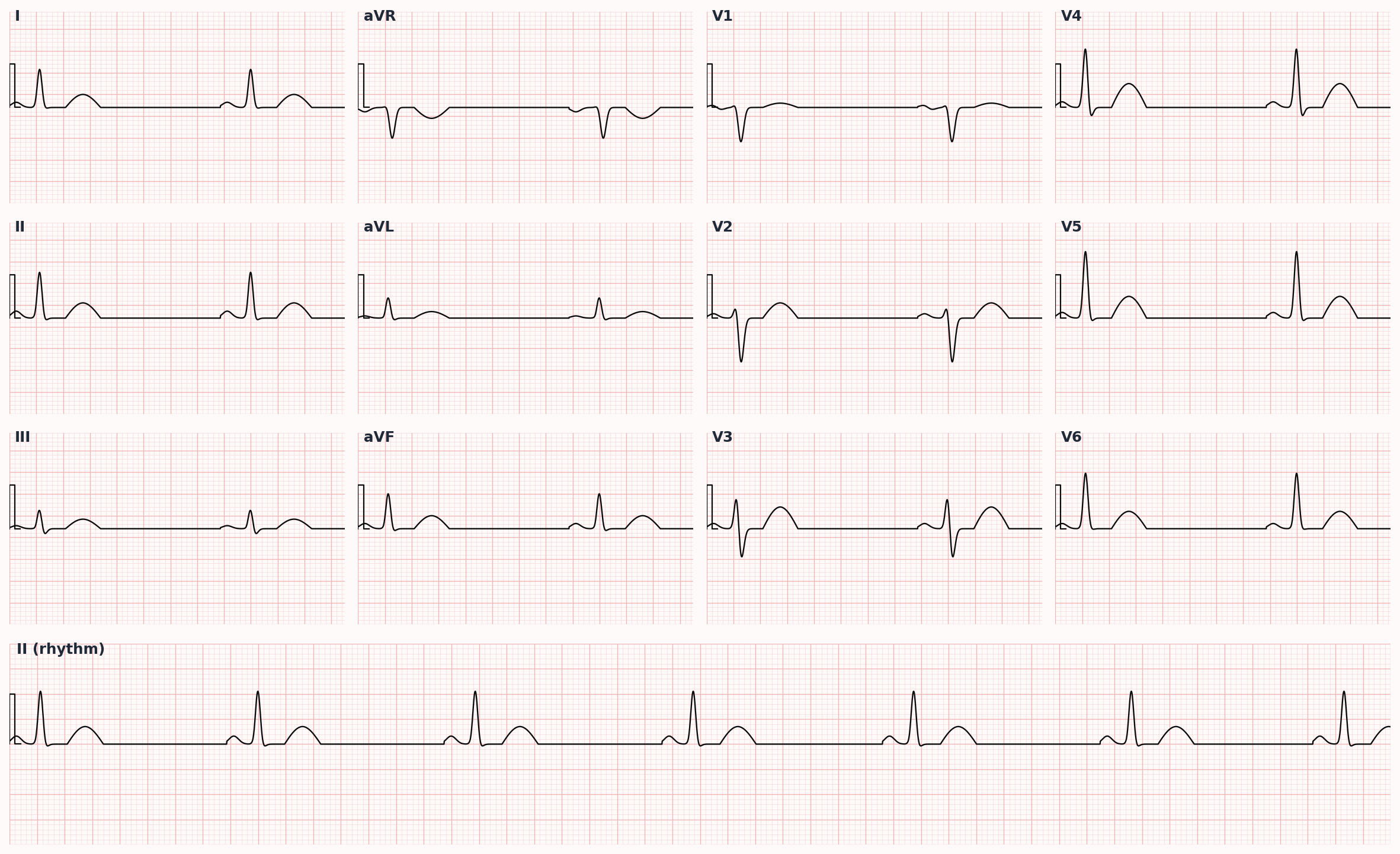 Sinus bradycardia — sinus rhythm at rate <60 bpm; persistent inappropriate bradycardia is a hallmark of SSS