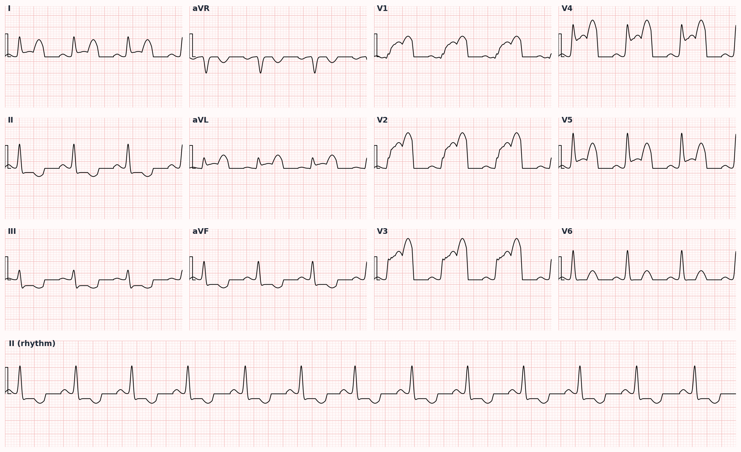 Anterior STEMI — ST-segment elevation in V1-V4 with reciprocal changes inferiorly