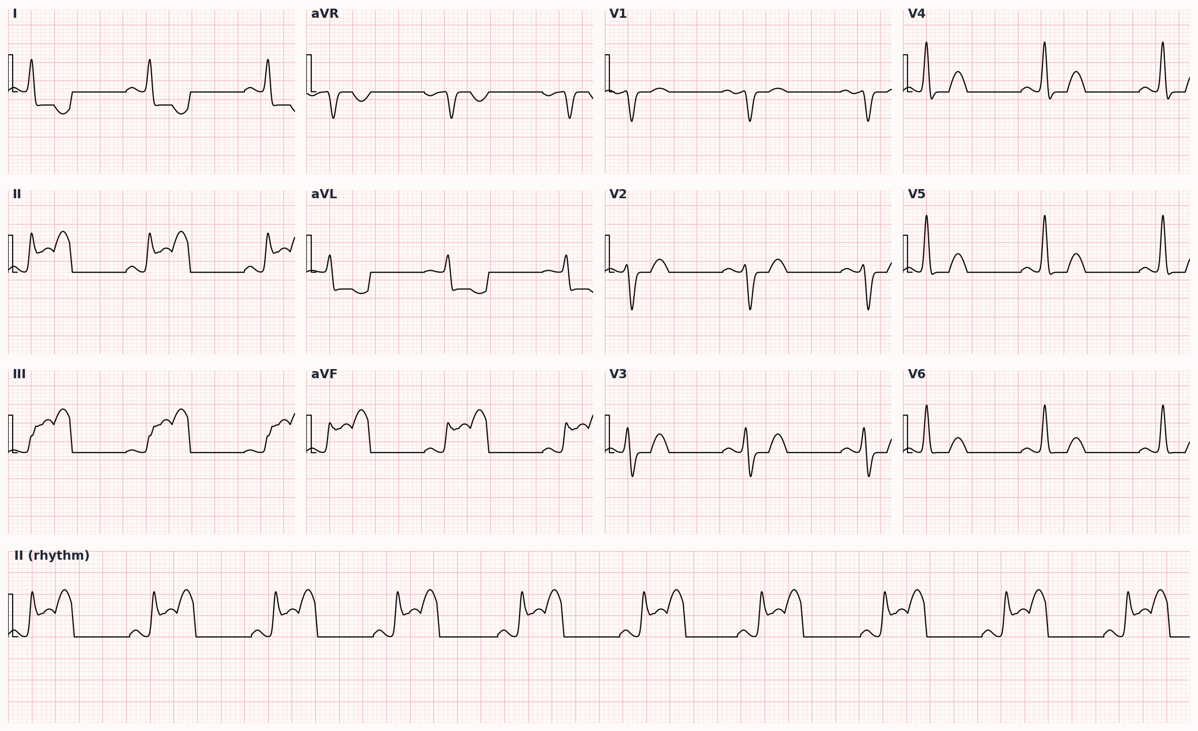 Inferior STEMI — ST elevation in II, III, aVF; reciprocal depression in I and aVL