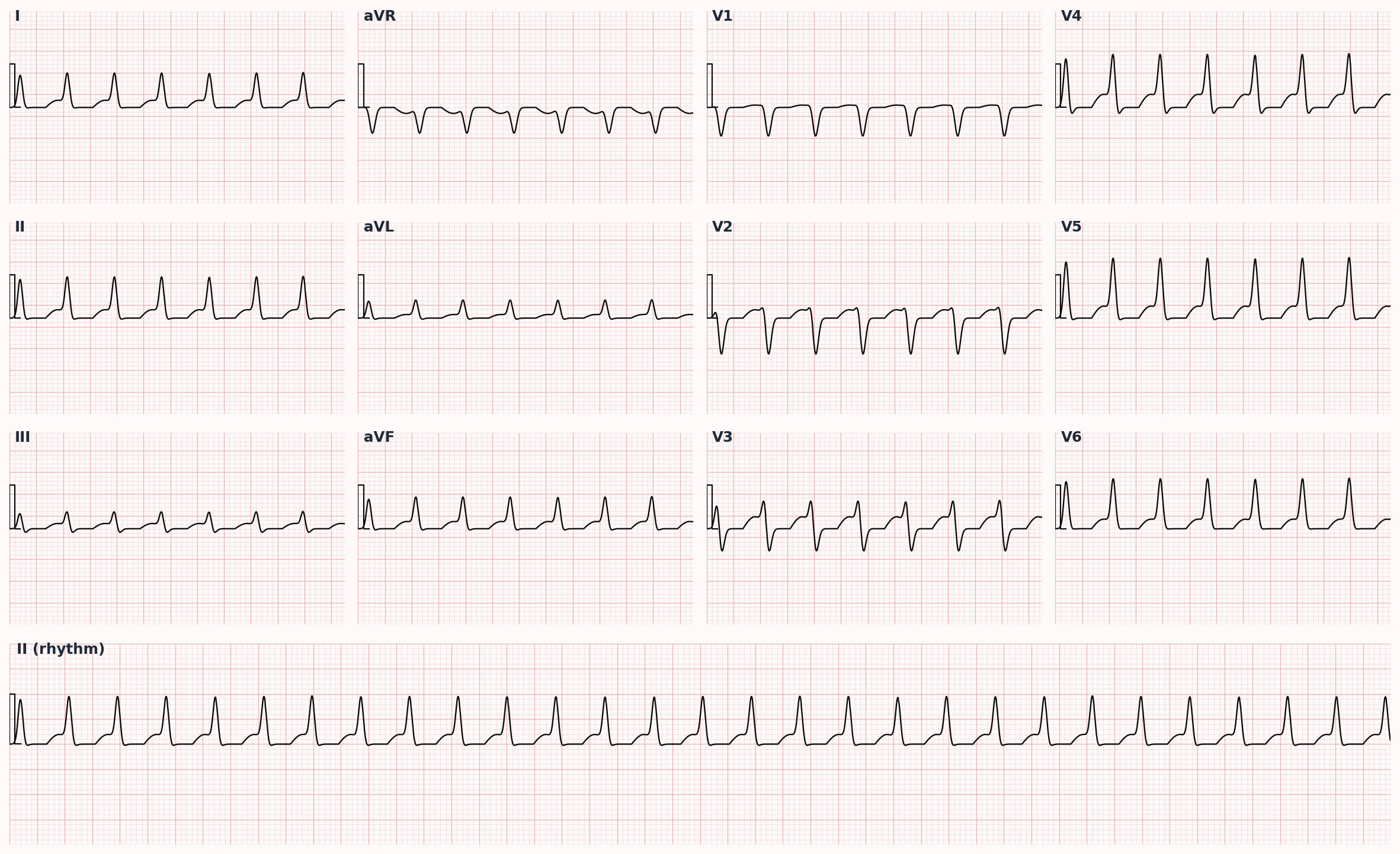 Supraventricular tachycardia — narrow-complex regular tachycardia, no visible P waves (retrograde, often buried)