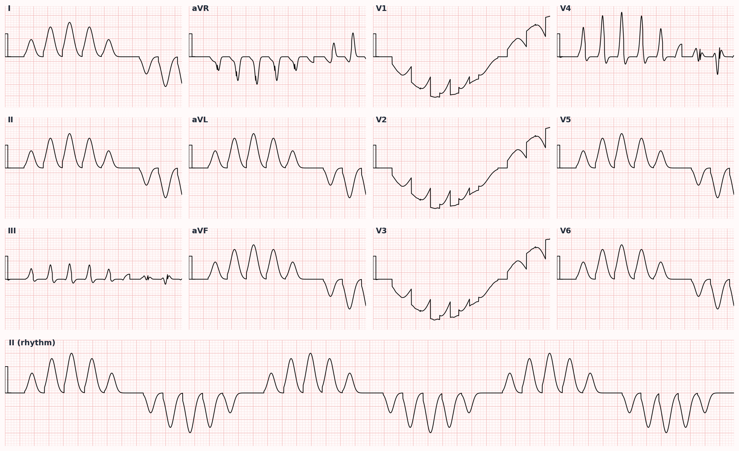 Torsades de pointes — the feared arrhythmia complication of long QT syndrome