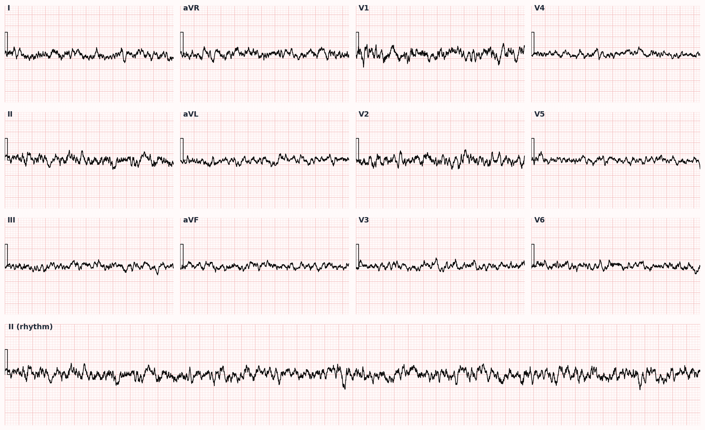Ventricular fibrillation — chaotic, disorganized electrical activity; immediate defibrillation indicated