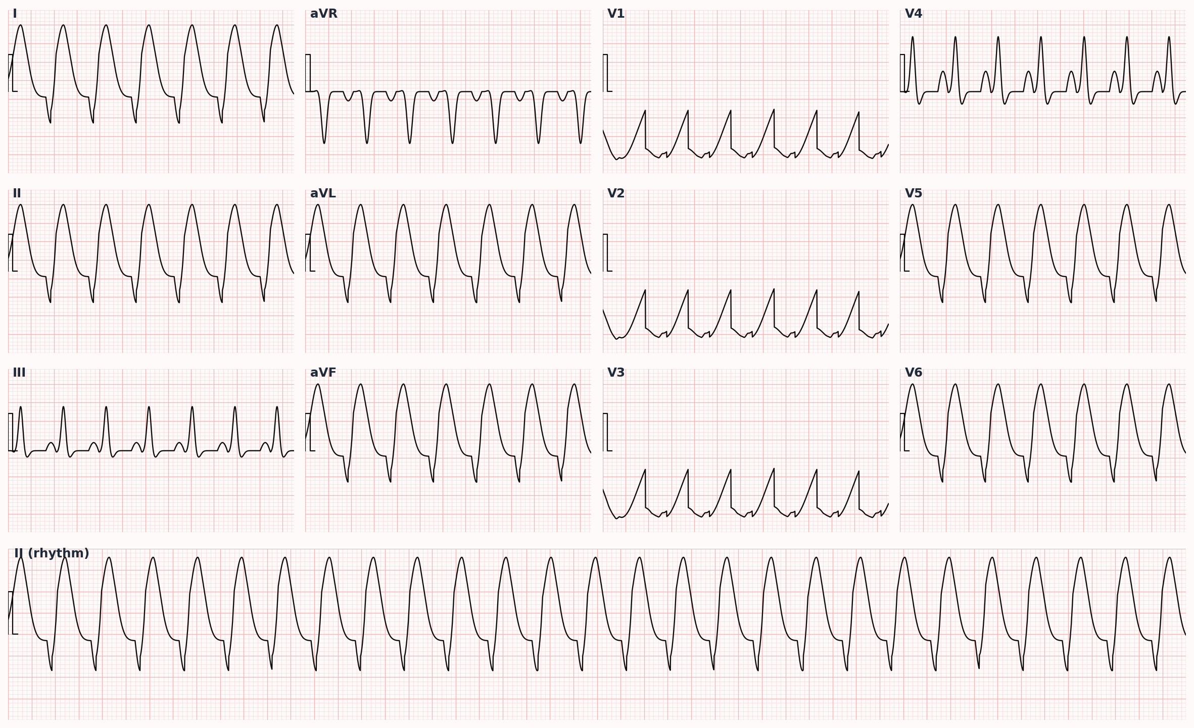 Monomorphic ventricular tachycardia — wide-complex tachycardia with uniform QRS morphology