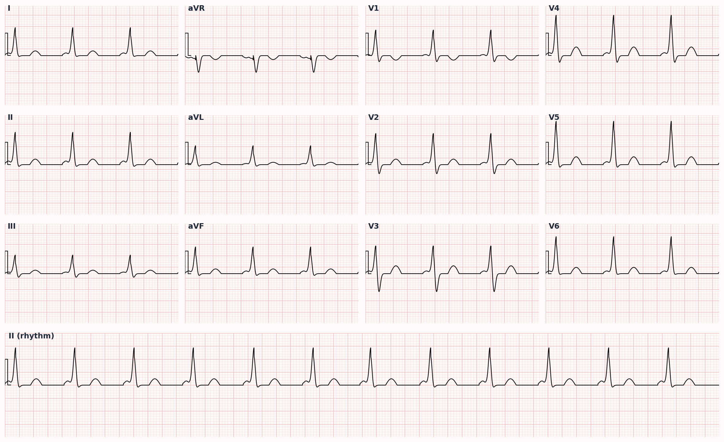 Wolff-Parkinson-White syndrome — short PR interval, delta wave (slurred QRS upstroke), wide QRS